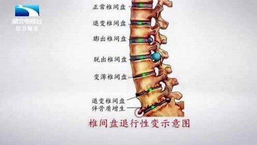 专家解析椎间盘退行性变示意图，膨出、突出和脱垂有啥不一样？