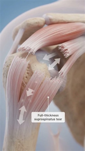 Rotator Cuff Tear Explained | Why the Shoulder Hurts & Feels Weak
