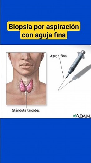 FINE NEEDLE ASPIRATION BIOPSY OF THYROID NODULES