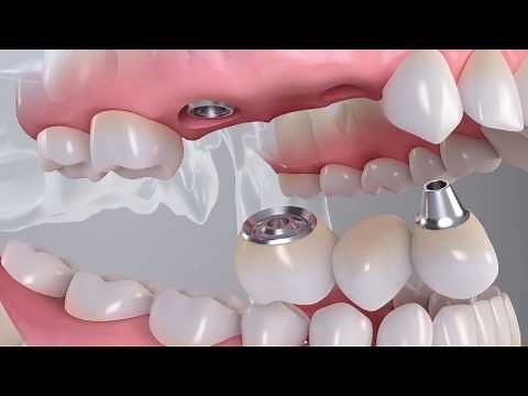 Cementation Aid for Straumann® Variobase® for Bridge/Bar Cylindrical