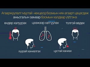 Боом өвчин гэж юу вэ?