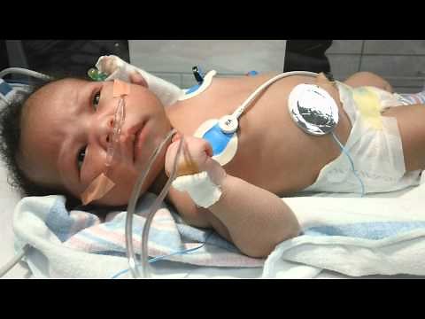 Neonatal Seizures