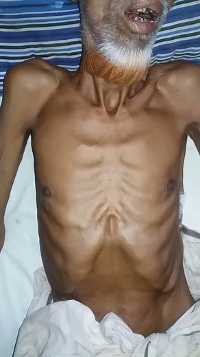 Asymmetric movement of chest