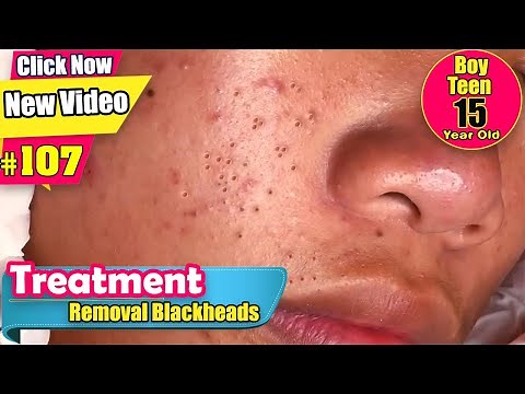 Blackhead Treatment For Young Boy 15 year old - Acne Treatment #107