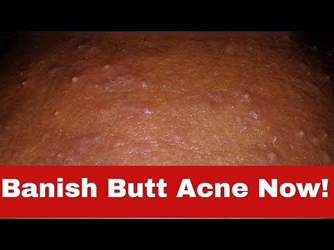 How to Get Rid of Butt Acne: Simple Tips That Actually Work!