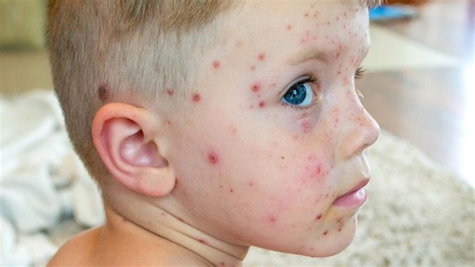 Measles Spread: Follow These Tips to Prevent Transmission In Your Household