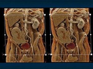 Fever and RLQ Pain From "CT of Lymphoma: Involvement of the GI Tract - Part 2" View the full lecture here: https://ctisus.com/media/2023/10/30/ct-of-lymphoma-involvement-of | CTisus: Cutting edge information on body CT (Computed tomography).