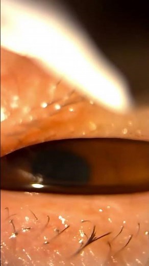 Unblocking oil glands in your eyelid with eyelid massage