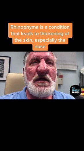 Sandra Lee, MD, FAAD, FAACS on Instagram: "Rhynophyma wedding ♥ #drpimplepopper #popaholics #dermatology #medicaleducation"