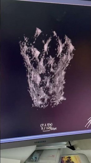 3D rotational angiography for TAVR - Evolut pro, Navitor vision, Sapien 3 ultra