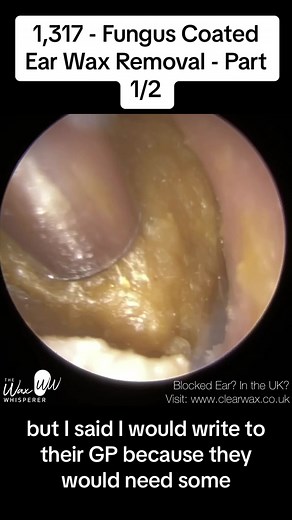 1,317 - Fungus Coated Ear Wax Removal #ear #earwax #earwaxremoval #earwaxcleaning #earwaximpaction #audiologist #thewaxwhisperer DISCLAIMER The information contained in the multimedia content (“Video Content”) posted has been made available for informational and educational purposes only. It does not make any representation or warranties with respect to the accuracy, applicability, fitness, or completeness of the Video Content. It does not warrant the performance, effectiveness or applicability 