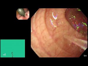 Endoscopy Top Tips: LGI - colonoscope insertion using the water immersion technique