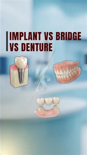 Dental Implant vs Bridge vs Denture: What’s Best?