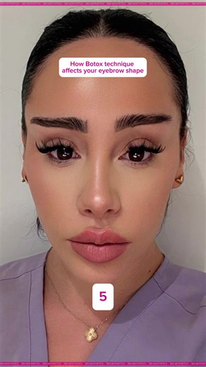 Your brow lift isn’t just how much Botox you get — it’s where the points are placed 👀 Tiny placement changes can lift, soften, or even over-arch the brow. That’s why precise mapping matters when you’re asking for that snatched-but-natural look 💉 Always communicate your desired brow shape — subtle lift, open eyes, or soft arch — because injection points = brow personality 🔍💁‍♀️ 📲 Book here: 447728313365 #Botox #DermalFillers #Aesthetics #Injectables #GlowUp