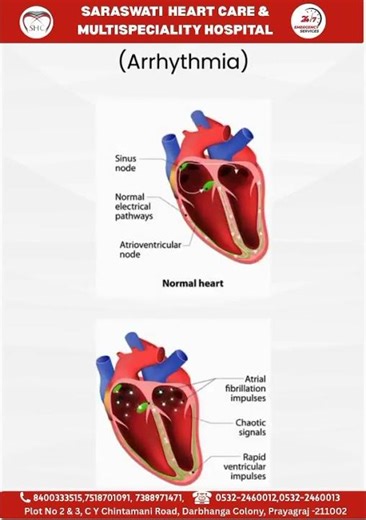 Arrhythmia Explained | Causes, Symptoms & Treatment | Best Heart Hospital in Prayagraj