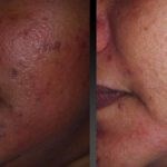 Glutathione Skin Lightening IV Injection Therapy Atlanta GA