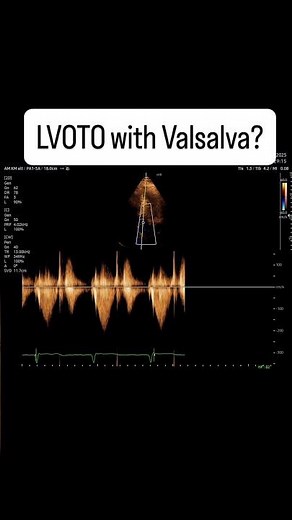 #Valsalva for provoking an #LVOT #gradient #echocardiography #ultrasound