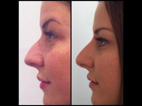 Nasenkorrektur ohne OP