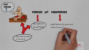 Tight Foreskin (Phimosis and Paraphimosis)