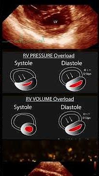 What is the D Sign? 📈 Echo Example Showing D Sign in Systole & Diastole!