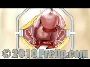 Hysterectomy Removal of Uterus, Ovaries and Fallopian Tubes Surgery PreOp® Patient Education