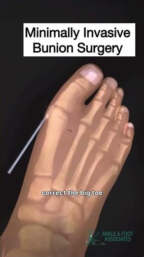 Minimally Invasive Bunion Surgery 🦶