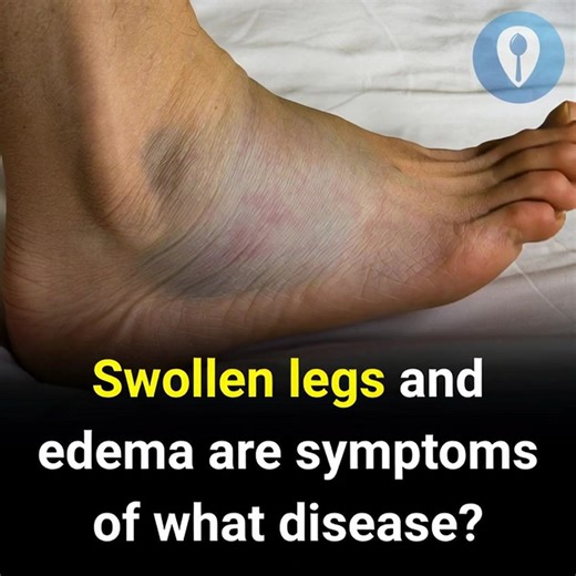 Which medical conditions are linked to leg swelling and edema? | The End