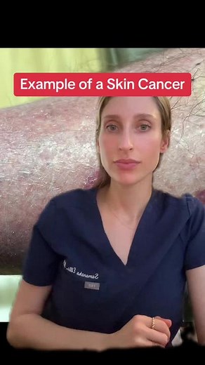 Sharing examples of skin cancer so that when you do your self skin exams you can have a more informed concept of things you should be looking for. #basalcellcarcinoma #skincancer #skinchecks #melanoma #skincancerawareness