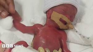 'Smallest baby at birth' home after 13 months in hospital