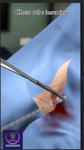 Holistic Health Treatment on Instagram: "A chest tube is a thin tube inserted into the chest to drain fluid, blood, or air that has accumulated around the lungs, which can impede breathing or cause lung collapse. Chest tube insertion is a medical procedure typically performed in a hospital setting to treat conditions like pneumothorax (collapsed lung), pleural effusion (fluid buildup), or hemothorax (blood buildup). The procedure involves making a small incision in the chest wall, inserting the