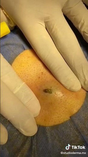 you won't expect this 💦😱💣 #cyst