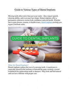 Guide to Various Types of Dental Implants - SlideServe