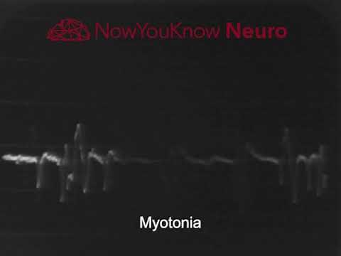 EMG: Myotonia