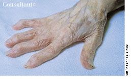 Heberden Nodes | Patient Care Online