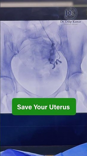 Fibroid Treatment Without Uterus Removal | UFE Explained by Dr. Dilip Kumar