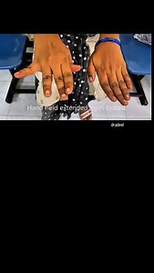 The Pinky That Escapes 👋 | Wartenberg Sign Ever noticed the little finger drifting outward when the hand is extended? 👀 That’s Wartenberg Sign — a subtle but powerful clue pointing toward ulnar nerve dysfunction. Seen in: ✔️ Ulnar neuropathy ✔️ Cervical myelopathy (Finger Escape Sign) ✔️ Stroke Also known as the Digiti Quinti Sign 📌 Small sign. Big neurological insight. Save & share with your med #WartenbergSign #ClinicalSigns #NeurologyBasics #UlnarNerve #MedicalReels | Adeel Ur Rehman