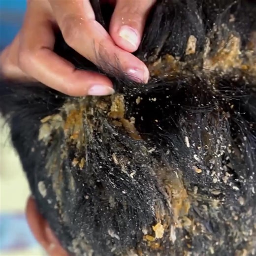 Hand Full Scratching Big Flakes With Comb !! - Dandruff Satisfying And Picking #219 Part 2 | Help remove ticks