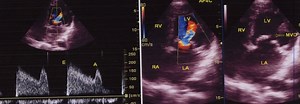 Assessment of mitral stenosis by echocardiography - All About Cardiovascular System and Disorders