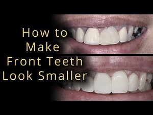 How to make front teeth not stick out