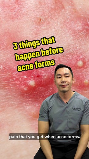 Acne Explained: 3 Causes & Treatments from a Dermatologist