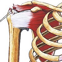 Torn Rotator Cuff Surgery, Treatment and Exercises