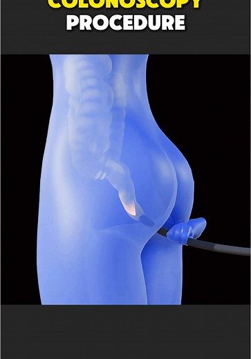 Understanding the Colonoscopy Procedure Explained