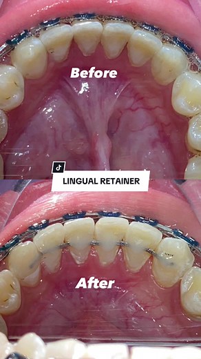 Dr Razz Demonstrates Lingual Retainer Installation!