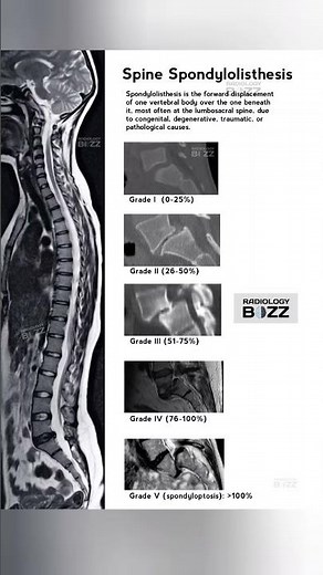🔎 Spondylolisthesis Explained! 🦴