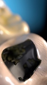 2.9M views · 15K reactions | A simple cavity can turn deadly if ignored. What starts as tooth decay can spiral into a painful abscess, then leak into your bloodstream, leading to sepsis. #toothdecay #dentalhealth #sepsis #oralcare #healthtips #cavitywarning #brushandfloss #dentist | Mr.BrainBoost | Facebook