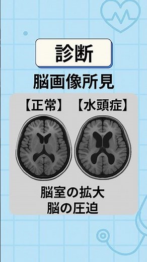 【疾患解説】水頭症とは？診断治療まで ＃水頭症 ＃正常圧水頭症 ＃リハ ＃作業療法 ＃理学療法 ＃国家試験 ＃看護学生