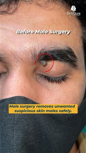 Mole Removal Before & After Results | Safe & Effective Skin Treatment