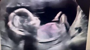 11K views · 415 reactions | Ab*rt*on doesn’t prevent the creation of...