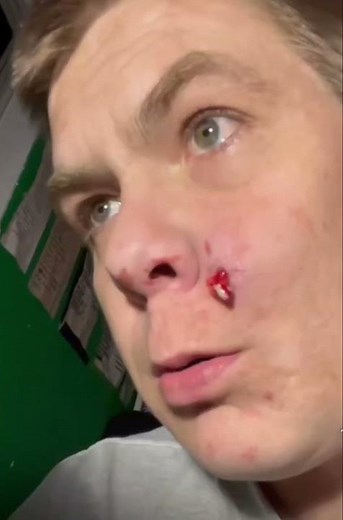 Abscess cyst pimple popped