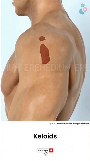 How To Get Rid of Keloids ↪ 3D Medical Animation #Shorts #Keloids